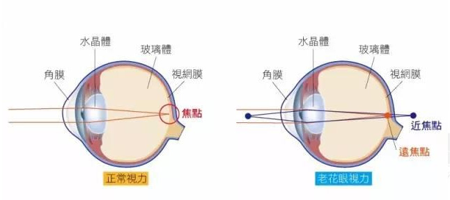 白內(nèi)障和老花眼區(qū)別，老花眼發(fā)病率正呈現(xiàn)年輕化趨勢