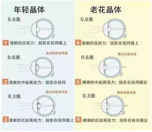近視就不會(huì)老花了嗎？